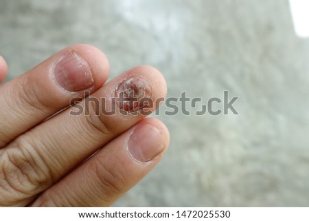 Close up of fungus nail infection. Fungal infection on nails hand, finger with onychomycosis, damage on human hand on gray concrete wall background. Disease and Symptom concept.