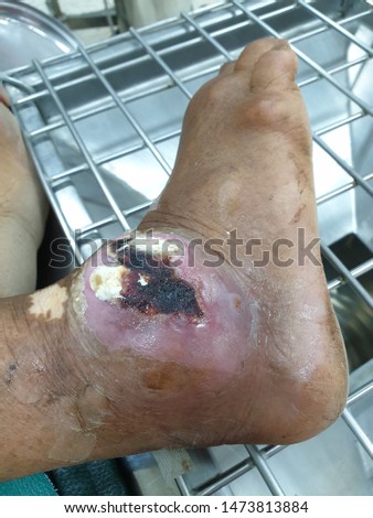 Foot ulcers in patients with gout, Inflammatory ulcers on the ankle, With pus and necrosis
 Royalty-Free Stock Photo #1473813884