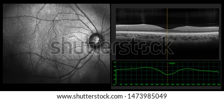Ophthalmic test - OCT optical coherence tomography measurement. SLO Scan view of the macula in retina with vessels Royalty-Free Stock Photo #1473985049