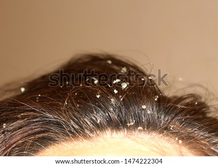 Dandruff on the hair. Hair disease seborrhea. Fatty Dandruff. Royalty-Free Stock Photo #1474222304