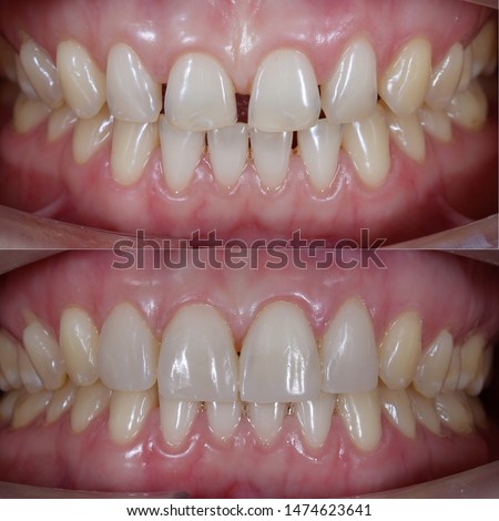 before and after of tooth filling for diastema closure by direct composite technique Royalty-Free Stock Photo #1474623641