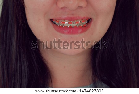 Asian girl in a brace was smiling