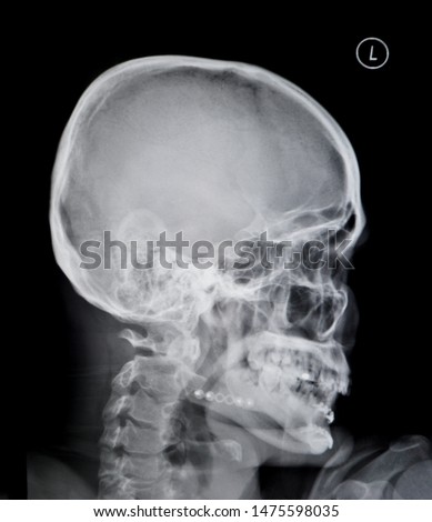 Film x-ray skull ,human's skull and c-spine                              