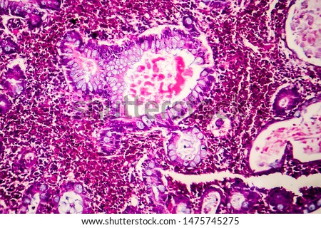 Villous colon adenocarcinoma, light micrograph, photo under microscope Royalty-Free Stock Photo #1475745275