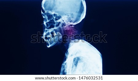 A lateral cervical spine x-ray showing pathologic odontoid fracture and displacement causing spinal cord compression or injury in a patient with spinal metastasis from lung cancer. Royalty-Free Stock Photo #1476032531
