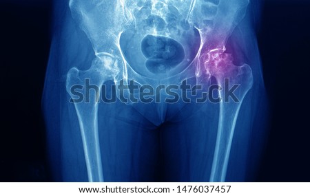 A pelvis and hip x-ray of a patient with hip pain showing avascular necrosis or AVN on both sides of the hips and secondary osteoarthritis. The patient needed total hip replacement. Royalty-Free Stock Photo #1476037457