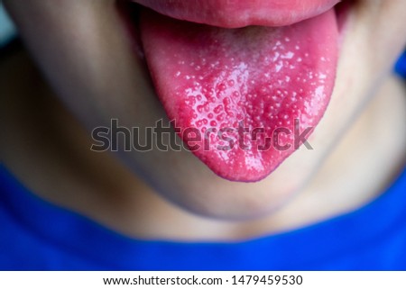 Strawberry tongue, sign of Streptococcus infection Royalty-Free Stock Photo #1479459530