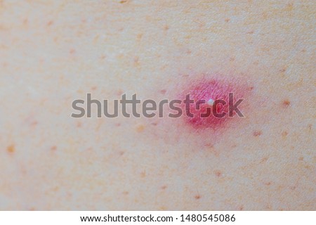 Close up photo of nodular cystic acne skin. Chronic acne skin on woman surface.  woman with acne problem, Close up of acne on the face skin caused by the hormone and the scars Royalty-Free Stock Photo #1480545086