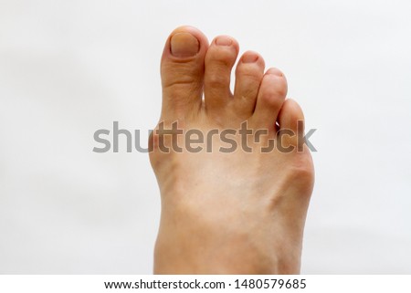 foot with gout on the bones on white background Royalty-Free Stock Photo #1480579685