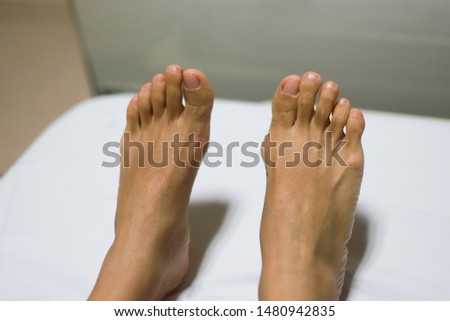  Hallux Valgus in an Asian girl before and after Proximal phalanx osteotomies. Left feet is after surgery and Right feet is befor surgery. Royalty-Free Stock Photo #1480942835