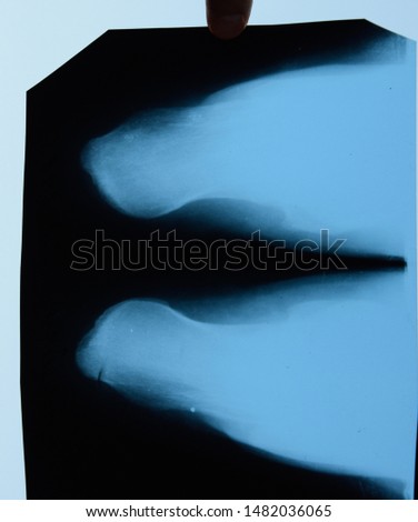 X-ray of feet and heel bones. X-ray picture of bones.