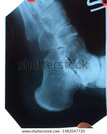 X-ray of feet and heel bones. X-ray picture of bones.