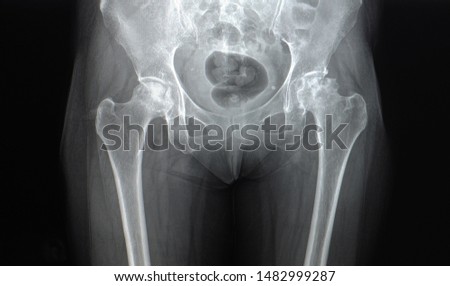 A pelvis and hip x-ray of a patient with hip pain showing avascular necrosis or AVN on both sides of the hips and secondary osteoarthritis. The patient needed total hip replacement. Royalty-Free Stock Photo #1482999287
