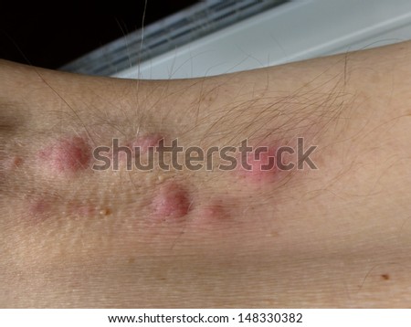 Acne inversa, hidradenitis suppurativa in the armpit, (inflammatory skin disease) Royalty-Free Stock Photo #148330382