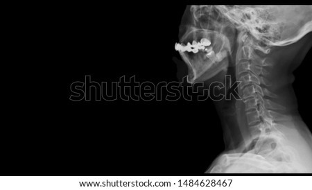 Film x ray spine radiograph show cervical spondylosis which is spinal disc degenerative disease. The patient is phone addiction and has radiculopathy and myeolopathy symptom. Medical imaging concept Royalty-Free Stock Photo #1484628467
