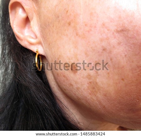 Photo of pigmentation spots on face Royalty-Free Stock Photo #1485883424