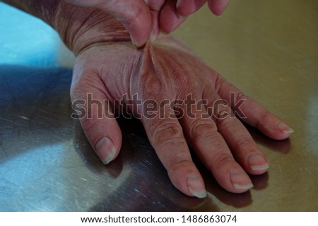 Pinching the back of a hand to test for dehydration on a stainless steel bench