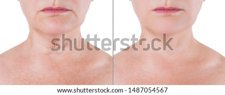 Skin rejuvenation on the neck, before after anti aging concept, wrinkle treatment, facelift and plastic surgery, half of body isolated on white background Royalty-Free Stock Photo #1487054567