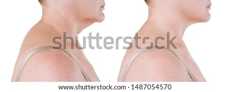Skin rejuvenation on the neck, before after anti aging concept, wrinkle treatment, facelift and plastic surgery, half of body isolated on white background Royalty-Free Stock Photo #1487054570