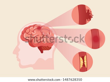 Stroke disease, ischemic, atherosclerosis and hemorrhagic. Scientific medical illustration of human brain stroke illustration. illustration, vector.