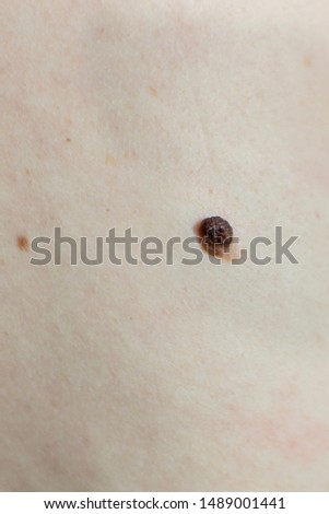 Photography of a brown mole on woman’s back