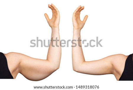 Before and after view of a Caucasian lady who had a brachioplasty Royalty-Free Stock Photo #1489318076