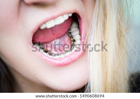 close-up, girl demonstrates invisible internal lingual braces, orthodontic treatment, free smile Royalty-Free Stock Photo #1490608694