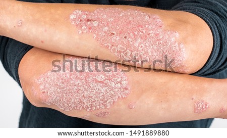 Man with sick hands, dry flaky skin on his hand with vulgar psoriasis, eczema and other skin diseases such as fungus, plaque, rash and blemishes. Autoimmune genetic disease. Royalty-Free Stock Photo #1491889880