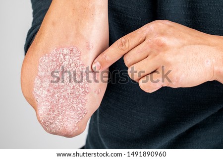 Man with sick hands, dry flaky skin on his hand with vulgar psoriasis, eczema and other skin diseases such as fungus, plaque, rash and blemishes. Autoimmune genetic disease. Royalty-Free Stock Photo #1491890960
