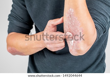 the use of emollient for dry flaky skin, as in the treatment of psoriasis, eczema and other diseases of dry skin Royalty-Free Stock Photo #1492044644