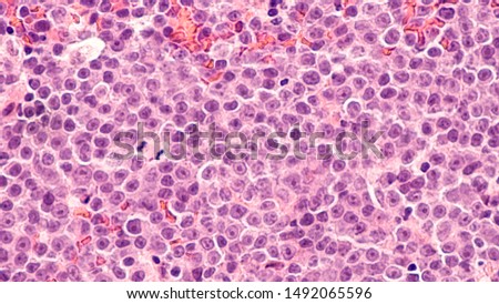 Lymphoma awareness: photomicrograph of a diffuse large B-cell lymphoma (DLBCL) a type of non-Hodgkin lymphoma.  This case is from the testis of an elderly man and shows prominent nucleoli.  Royalty-Free Stock Photo #1492065596