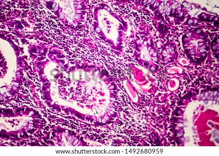 Villous colon adenocarcinoma, light micrograph, photo under microscope Royalty-Free Stock Photo #1492680959