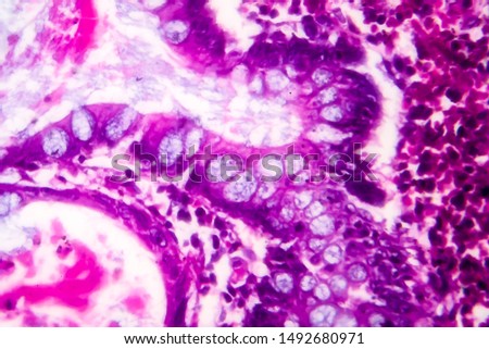 Villous colon adenocarcinoma, light micrograph, photo under microscope. High magnification Royalty-Free Stock Photo #1492680971