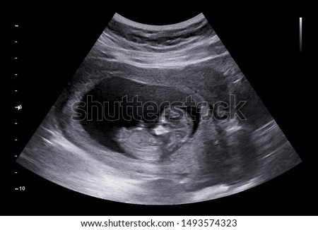 Ultrasound small baby at 12 weeks. 12 weeks pregnant ultrasound image show baby or fetus development and pregnancy health checking. Royalty-Free Stock Photo #1493574323