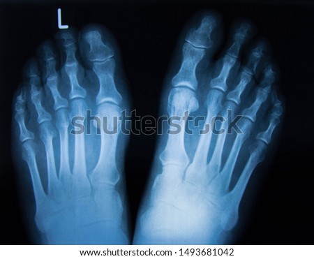 X-ray image of normal foot both side