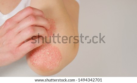 CLOSE UP: Unrecognizable young woman suffering from autoimmune incurable dermatological skin disease called psoriasis. Female gently scratching red, inflamed, scaly rash on elbows. Psoriatic arthritis Royalty-Free Stock Photo #1494342701