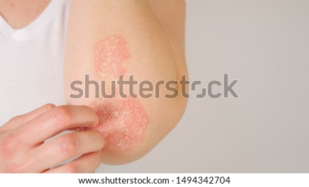 CLOSE UP: Unrecognizable young woman suffering from autoimmune incurable dermatological skin disease called psoriasis. Female gently scratching red, inflamed, scaly rash on elbows. Psoriatic arthritis Royalty-Free Stock Photo #1494342704