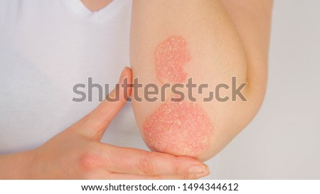 CLOSE UP: Unrecognizable young woman suffering from autoimmune incurable dermatological skin disease called psoriasis. Large red, inflamed, flaky rash on elbows. Joints affected by psoriatic arthritis Royalty-Free Stock Photo #1494344612