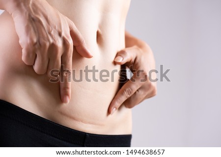Closeup of woman showing on her belly dark scar from a cesarean section. Healthcare concept. Royalty-Free Stock Photo #1494638657