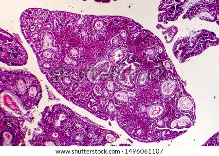 Villous colon adenocarcinoma, light micrograph, photo under microscope Royalty-Free Stock Photo #1496061107
