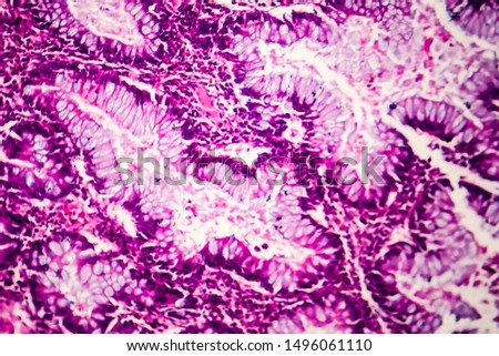 Villous colon adenocarcinoma, light micrograph, photo under microscope Royalty-Free Stock Photo #1496061110