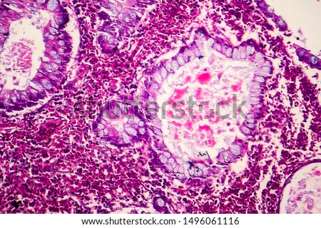 Villous colon adenocarcinoma, light micrograph, photo under microscope Royalty-Free Stock Photo #1496061116