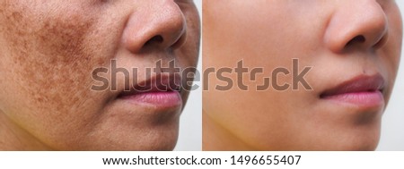 Image before and after spot melasma pigmentation skin facial treatment on face asian woman. Problem skincare and health concept.  Royalty-Free Stock Photo #1496655407
