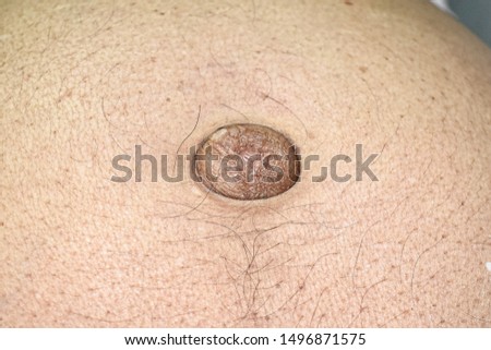 Large congenital umbilical hernia protruding from anterior abdominal wall in Asian elderly man. It is an abnormal bulge that can be seen at the umbilicus (belly button). Royalty-Free Stock Photo #1496871575