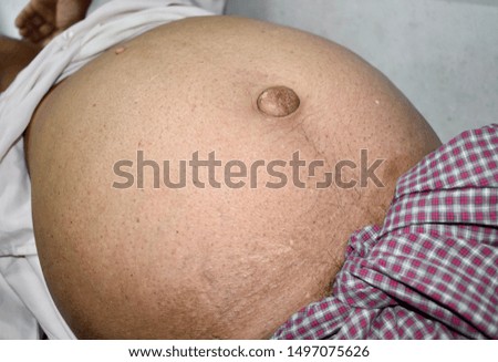 Prominent abdominal distension with umbilical hernia in Southeast Asian, Indian man in a clinic of Myanmar. Distended abdomen may be due to ascites, intestinal obstruction or fat. Royalty-Free Stock Photo #1497075626