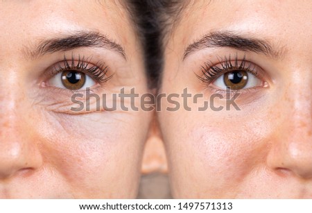 A young woman shows the before and after results of successful blepharoplasty surgery, corrective procedure to remove puffy and swollen bags beneath the eye. Royalty-Free Stock Photo #1497571313