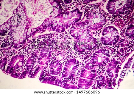 Villous colon adenocarcinoma, light micrograph, photo under microscope Royalty-Free Stock Photo #1497686096