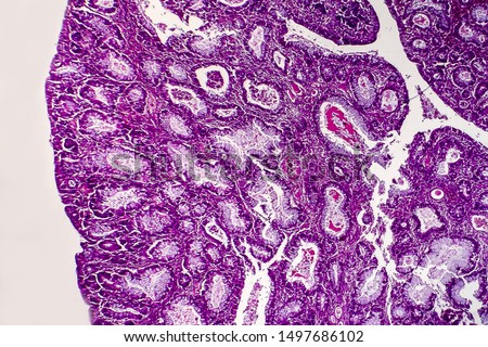 Villous colon adenocarcinoma, light micrograph, photo under microscope Royalty-Free Stock Photo #1497686102