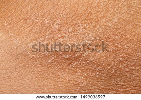 A macro view of human skin filling the frame, details of the lines and cracks and flaky shedding skin, skincare and dermatology concept with room for copy. Royalty-Free Stock Photo #1499036597