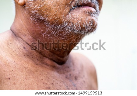 Elderly man's gray beard. Dermatology senior
